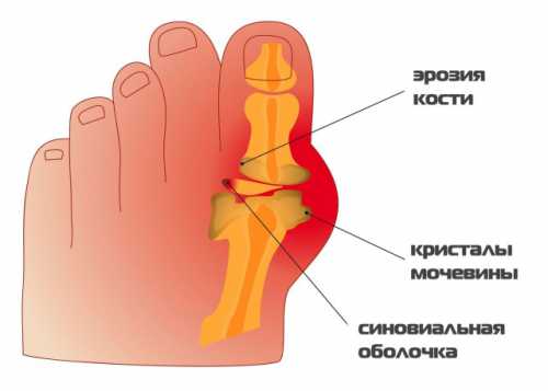 ветрянка у взрослых: причины, симптомы и лечение